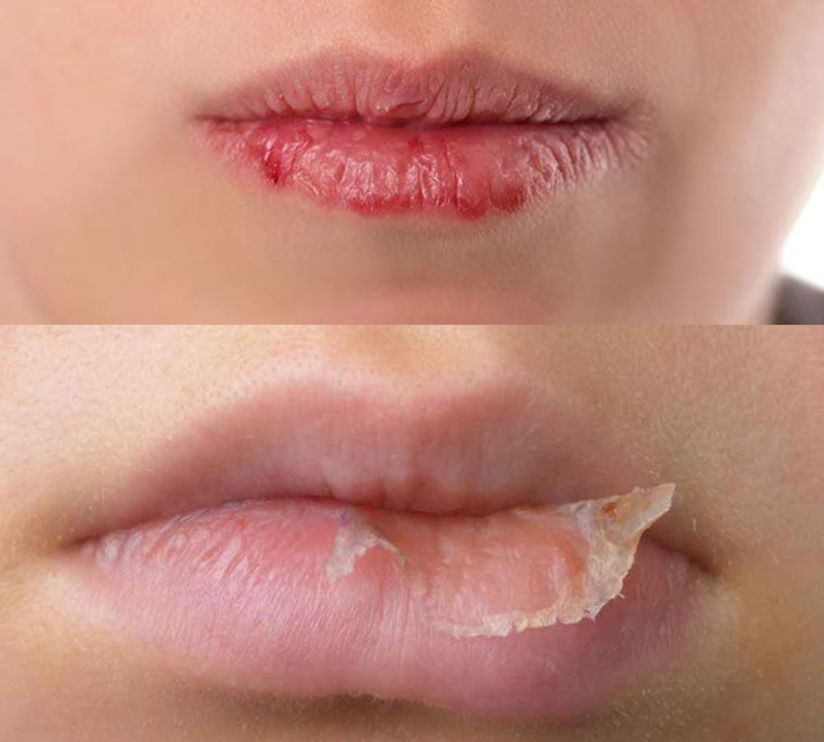 môi khô bong tróc không dùng son dưỡng có màu