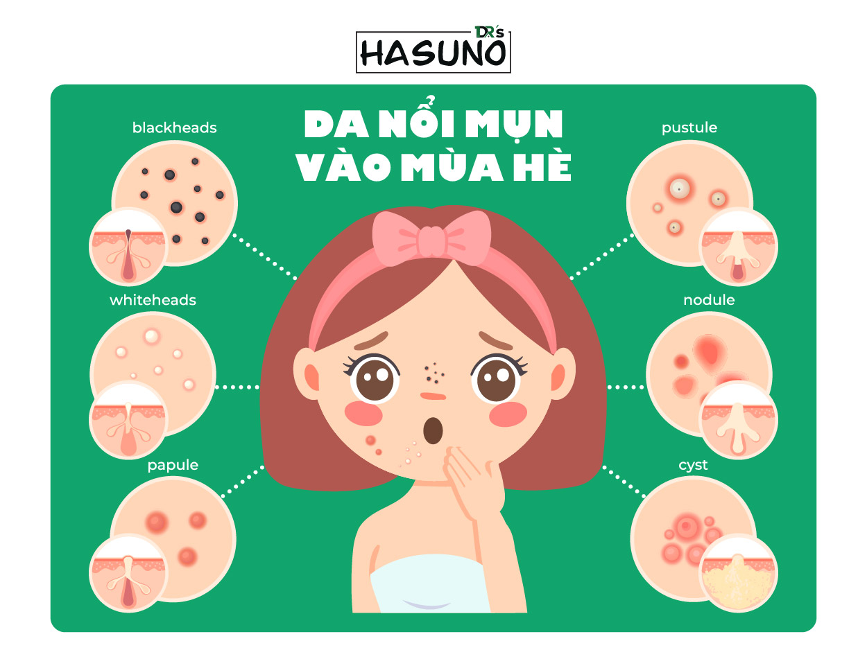 DA NỔI MỤN VÀO MÙA HÈ